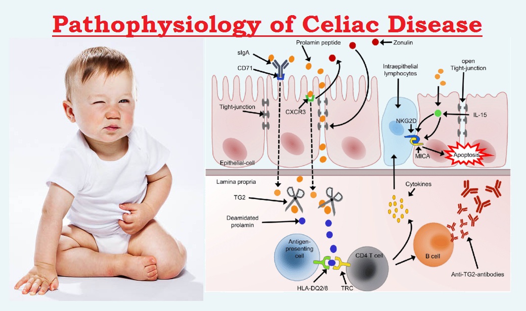 Celiac Disease : Sign & Symptoms, Risk Factors, Diagnosis ...