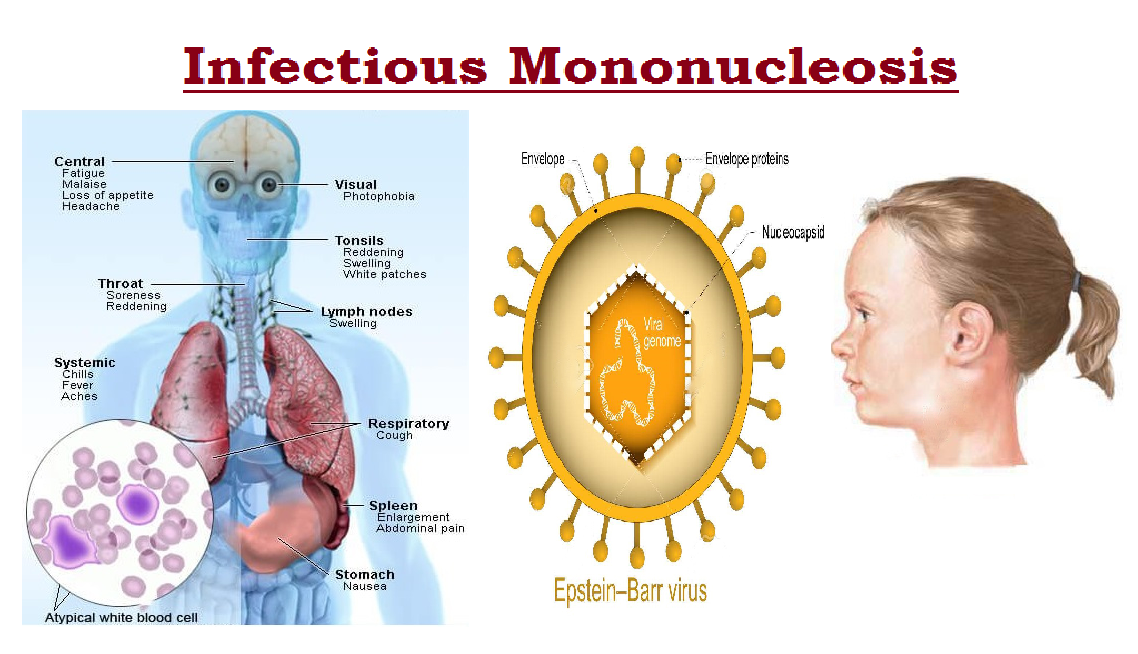 mono symptoms