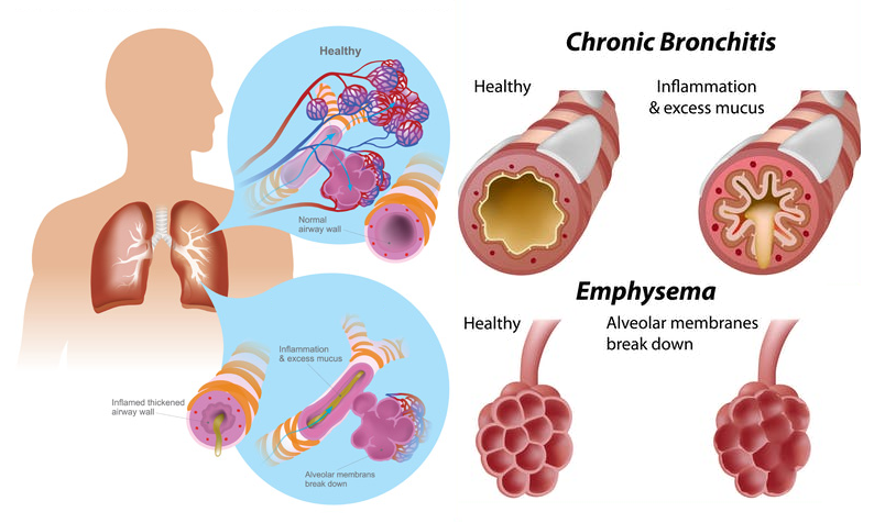 Chronic Obstructive Pulmonary Disease COPD MedicoInfo