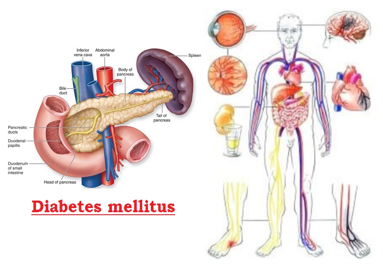 Diabetes mellitus : Sign & Symptoms, Causes, Diagnosis, Complication,  Treatment, Control & Prevention 4.8 (3613)