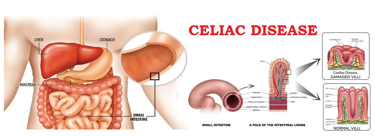 Celiac Disease : Sign & Symptoms, Risk Factors, Diagnosis, Complications, Treatment & Prevention 4.8 (1862)
