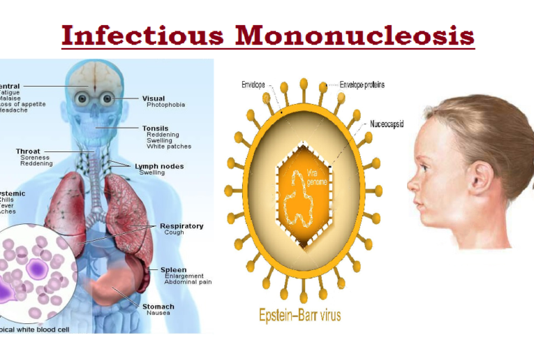 Infectious mononucleosis 4.8 (1572)