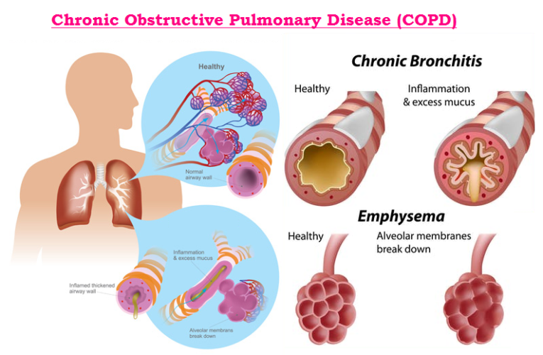 Chronic obstructive pulmonary disease (COPD) Archives - MedicoInfo