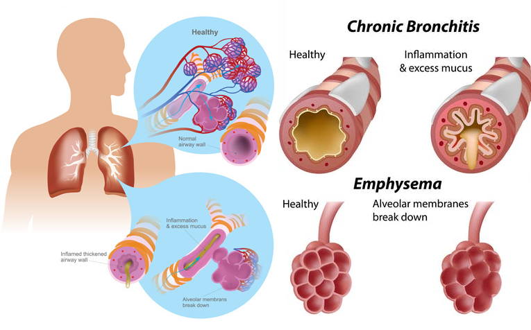 Chronic Obstructive Pulmonary Disease (COPD) 4.8 (3880)