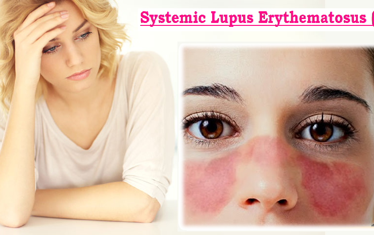 Systemic Lupus Erythematosus (SLE) 4.8 (2192)