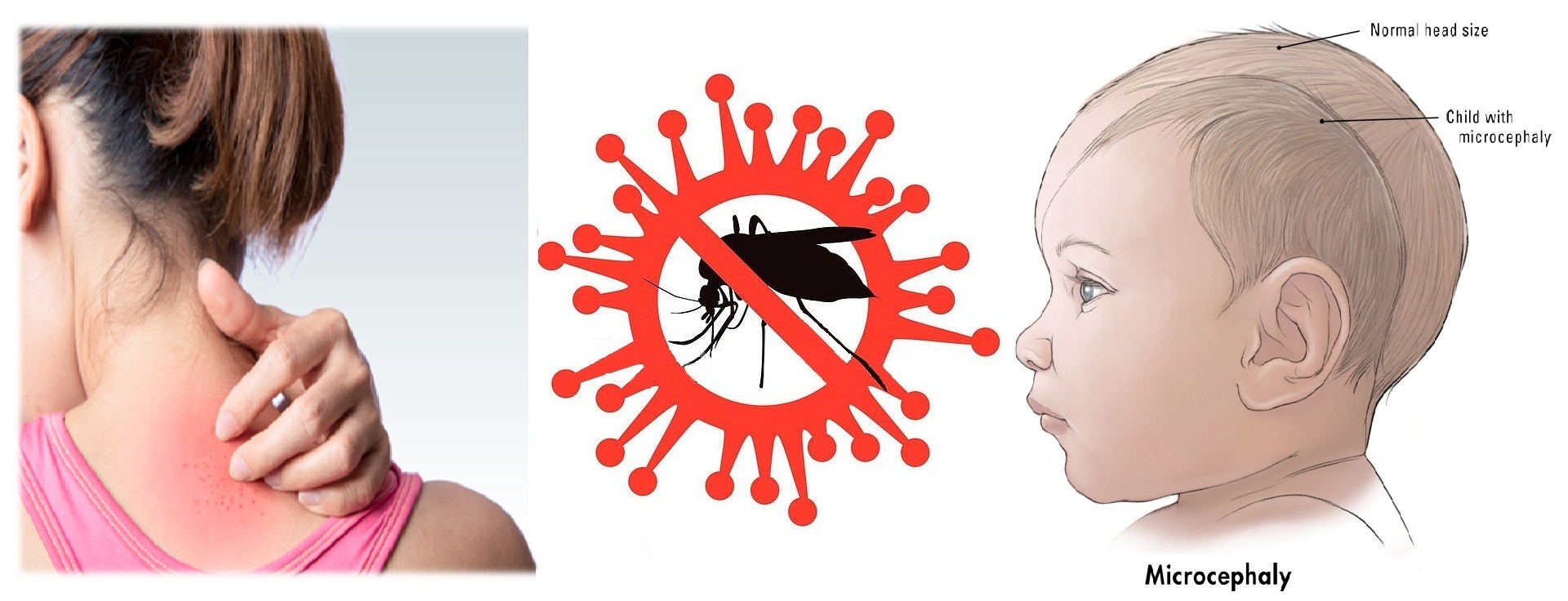 Zika virus Infection: Causes, Sign & Symptoms, Mode of Transmission, Diagnosis, Complication, Treatment and Prevention 5 (2)
