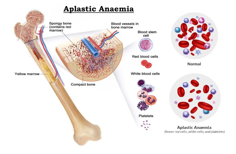 Aplastic Anaemia: Sign and Symptoms, Causes, Risk factors, Diagnosis, Complications, Treatment and Prevention 4.7 (6)