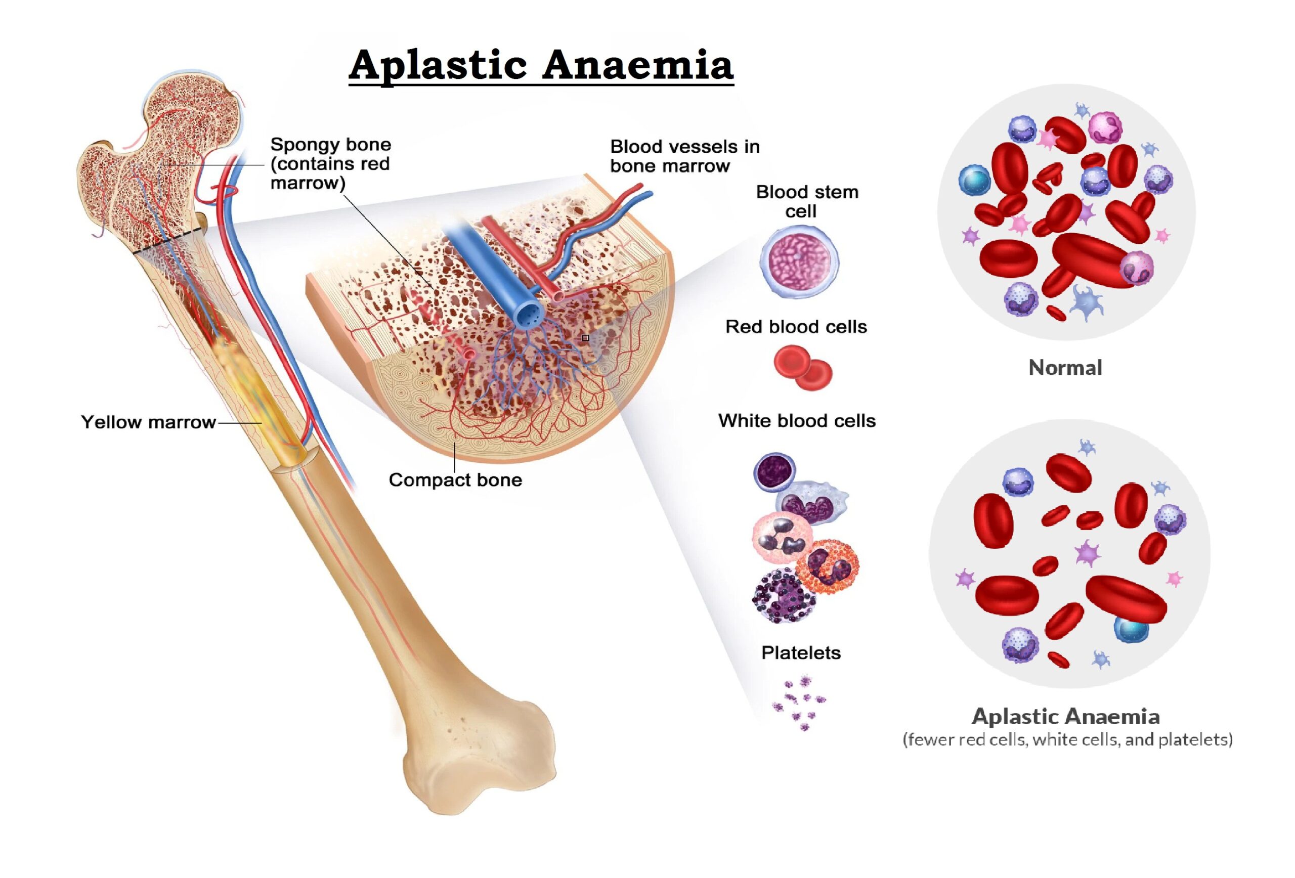 Anemia - Symptoms and Causes