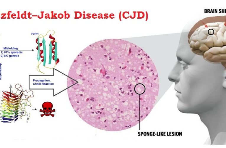 Cjd Rash Causes of Creutzfeldt–Jakob Disease Archives - MedicoInfo