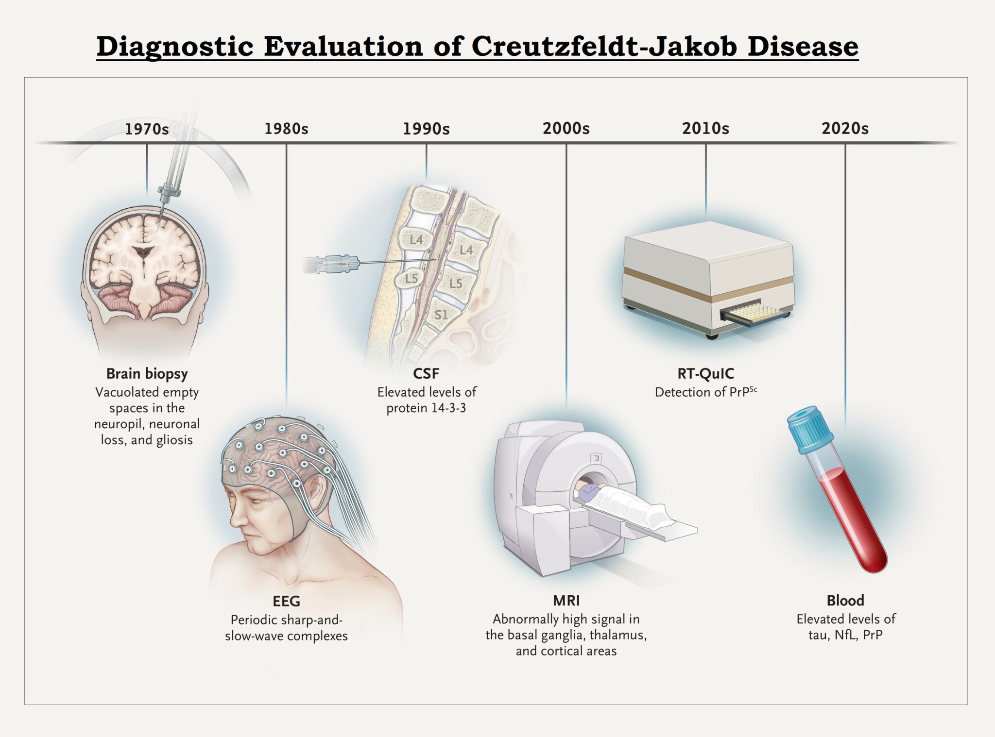 Creutzfeldt Jakob Disease CJD Sign And Symptoms Risk Factors 