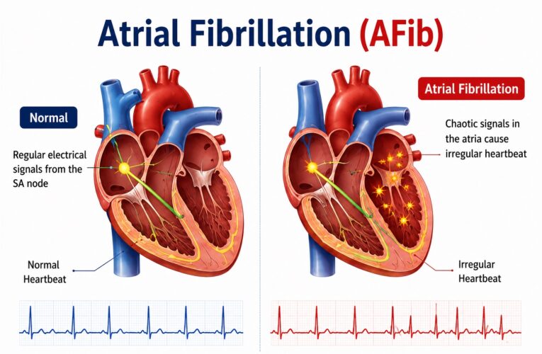 Atrial Fibrillation (AFib) – Sign and Symptoms, Risk Factors, Diagnosis, Complications, Treatment and Prevention 4.9 (5746)